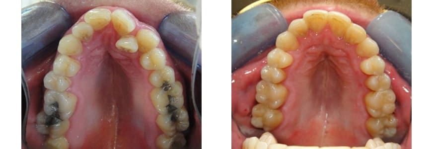 532-min before and after Invisalign comparison fixing Anterior Crossbite