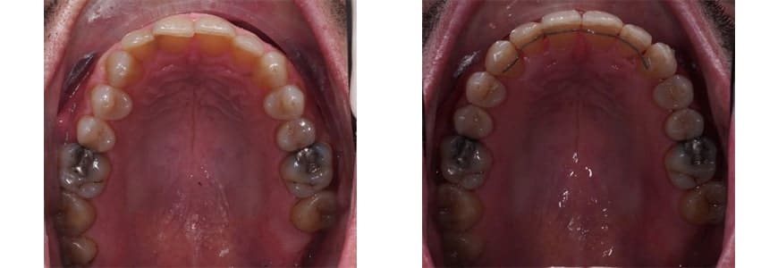 546-min Invisalign comparison fixing Rotations in a patients mouth after 10 months