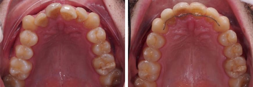590-min before and after Invisalign comparison fixing Anterior Crossbite
