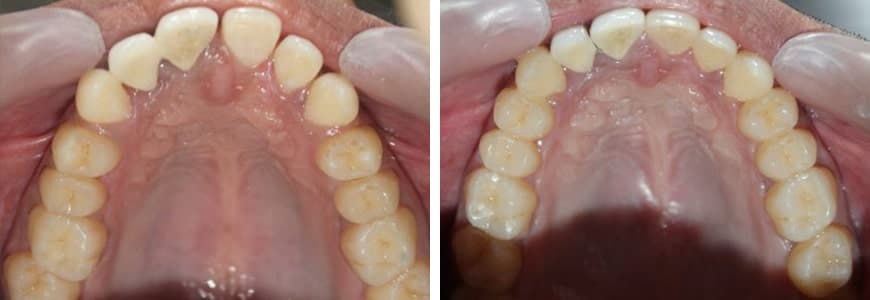 618-min before and after Invisalign comparison fixing spacing issues between teeth