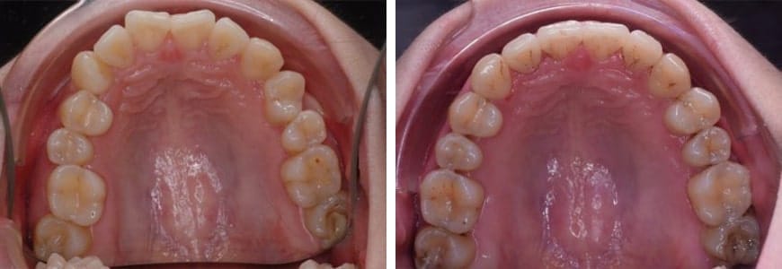 634-min Invisalign comparison fixing Rotations in a patients mouth after 10 months