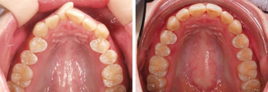 637-min Invisalign comparison fixing Rotations in a patients mouth after 10 months