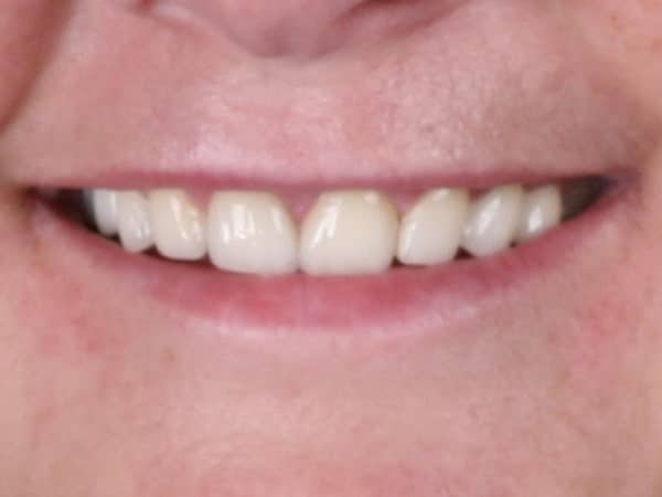 Patient after closeup diastema closure porcelain veneers