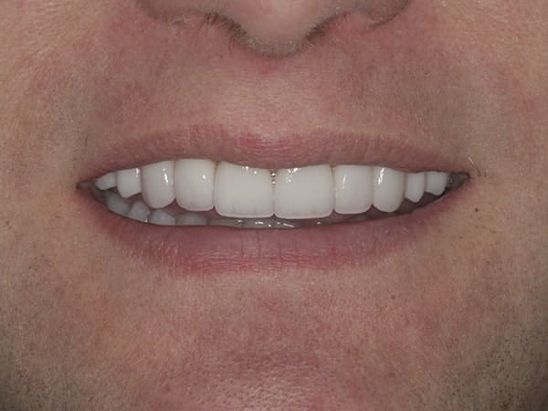 Patient after neuromuscular orthotic therapy