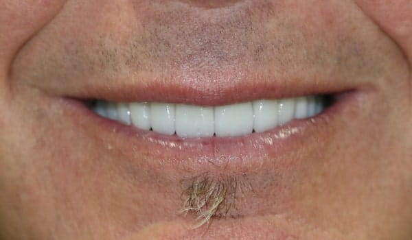 Patient after older restorations porcelain veneers