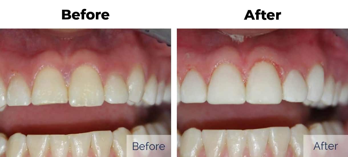 Before and after of full mouth dental work showing brighter whiter teeth with cosmetic bonding treatment