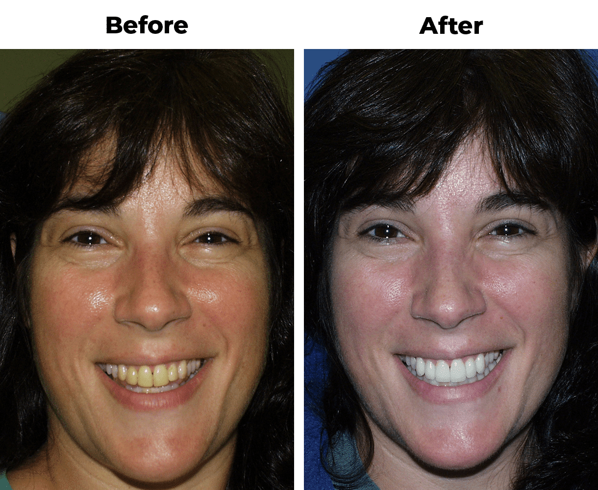 Before and after photos showing woman’s brighter smile after filling replacement with porcelain veneers