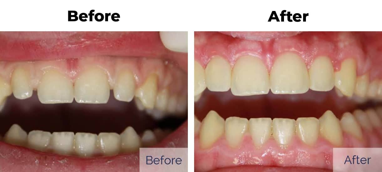 Before and after photos of a patient with gapped teeth corrected through cosmetic bonding