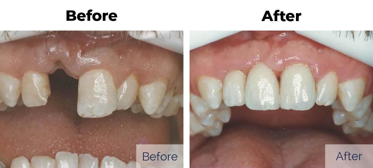Before and after photos of a patient with a missing tooth restored using a dental bridge