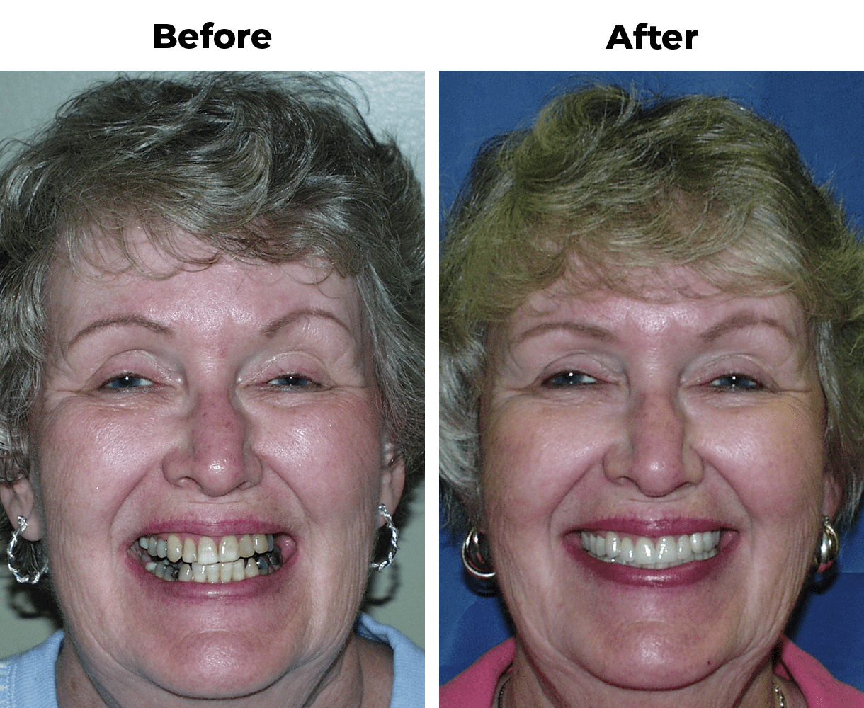 Before and after photos showing a woman with smile transformation through partial dentures and porcelain veneer treatment