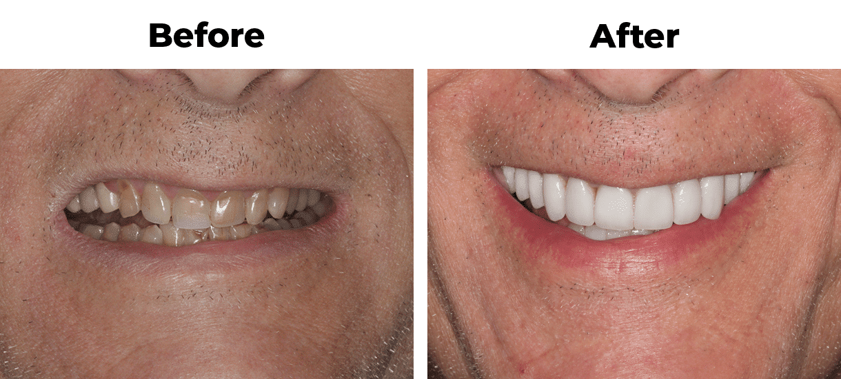Close up before and after of man’s teeth showing full dental reconstruction
