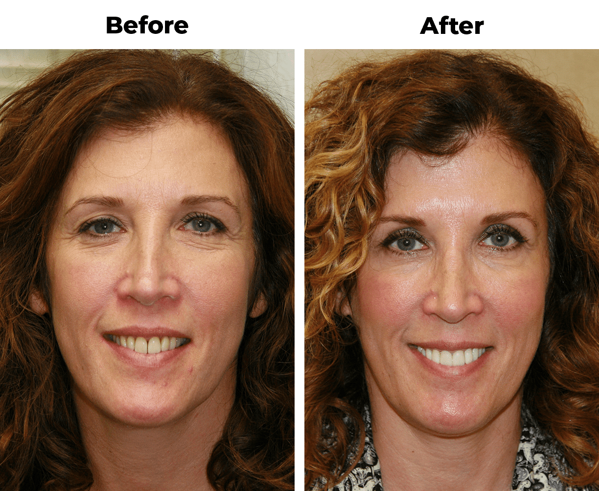 Before and after photos of a woman’s improved smile after teeth whitening and porcelain veneer work