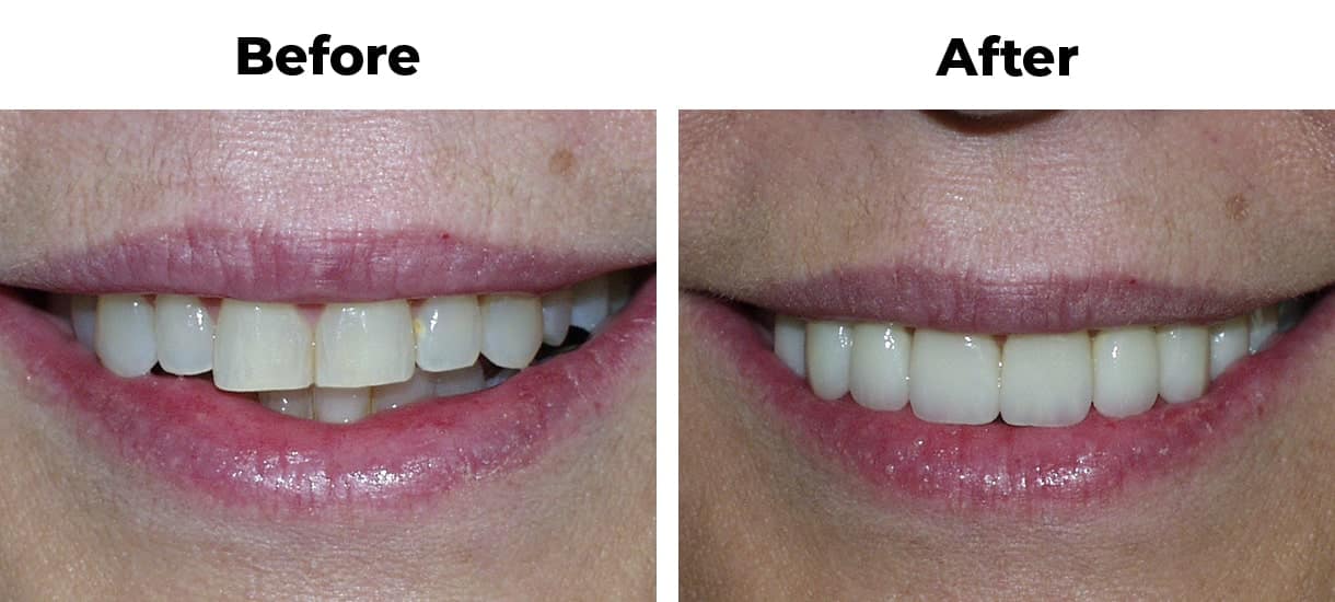 Close up before and after photos showcasing a porcelain veneers result