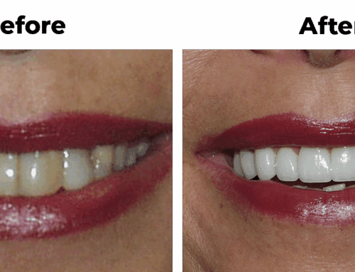 Can You Get Veneers with Missing Teeth?