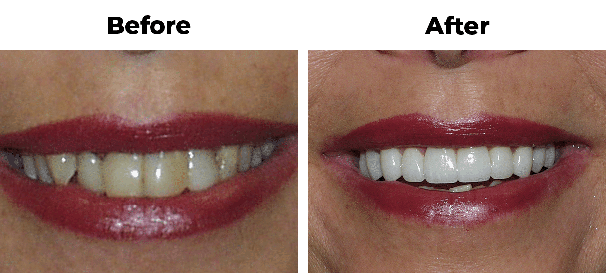 Before and after of woman’s smile with dental work creating straighter brighter teeth