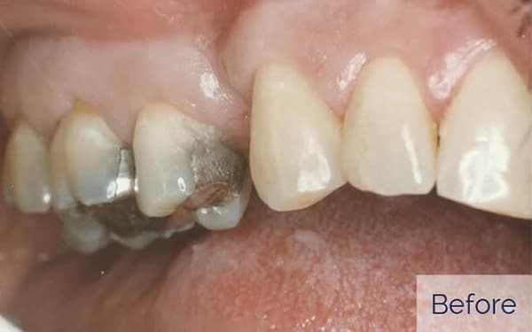Patient before replacing missing tooth