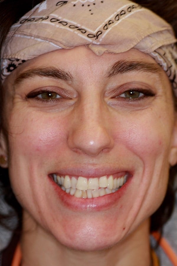 Patient before teeth straightening invisalign