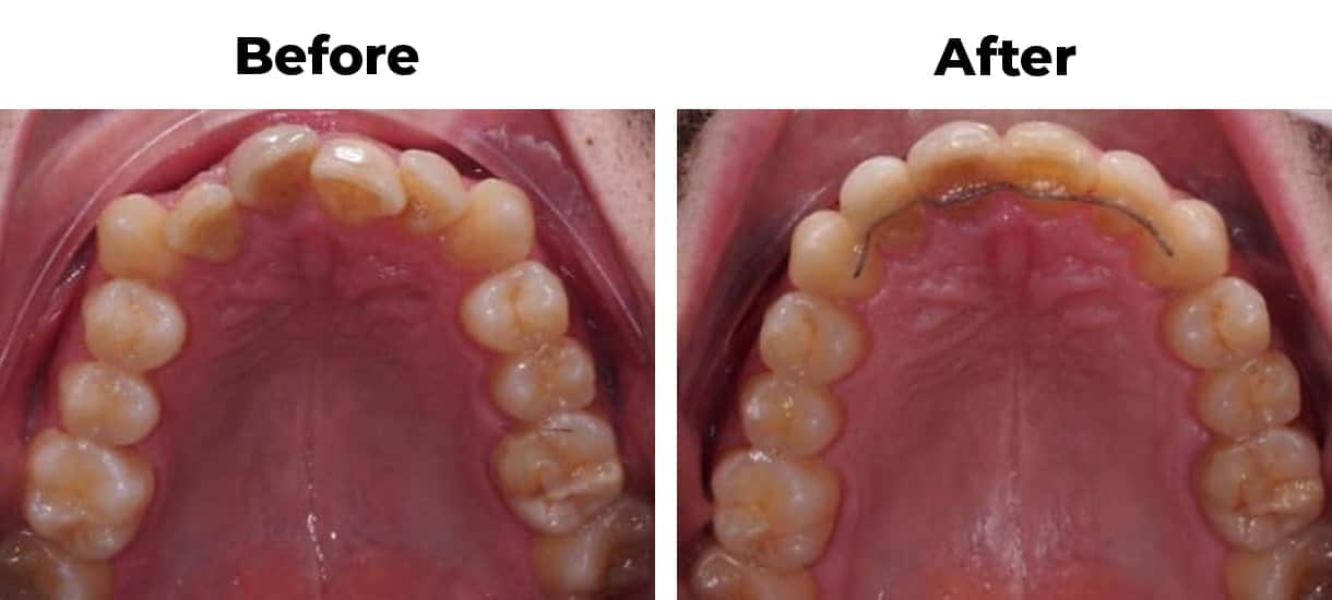 Rotated overcrowding overlapping invisalign before and after treatment