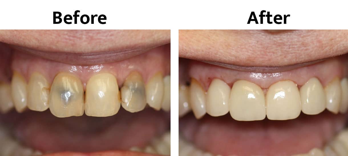 Close up before and after of teeth showing replacement of dark front teeth with natural looking restorations