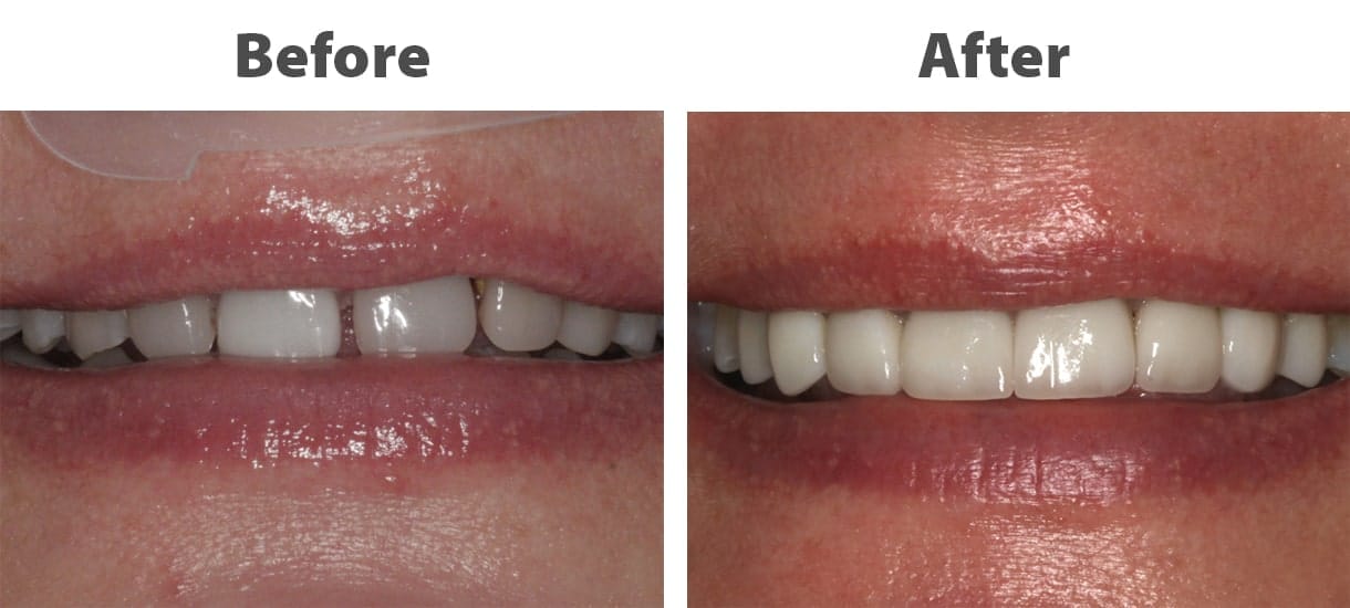 Close up before and after of teeth with veneers for a straighter whiter smile