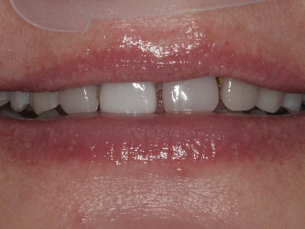 patient's smile before treatment
