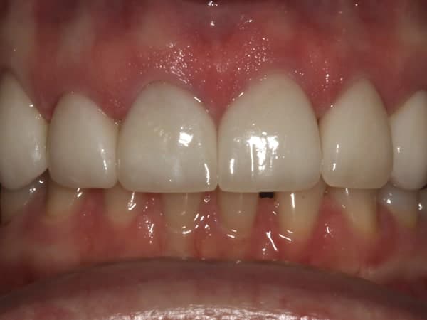 patient's mouth after treatment