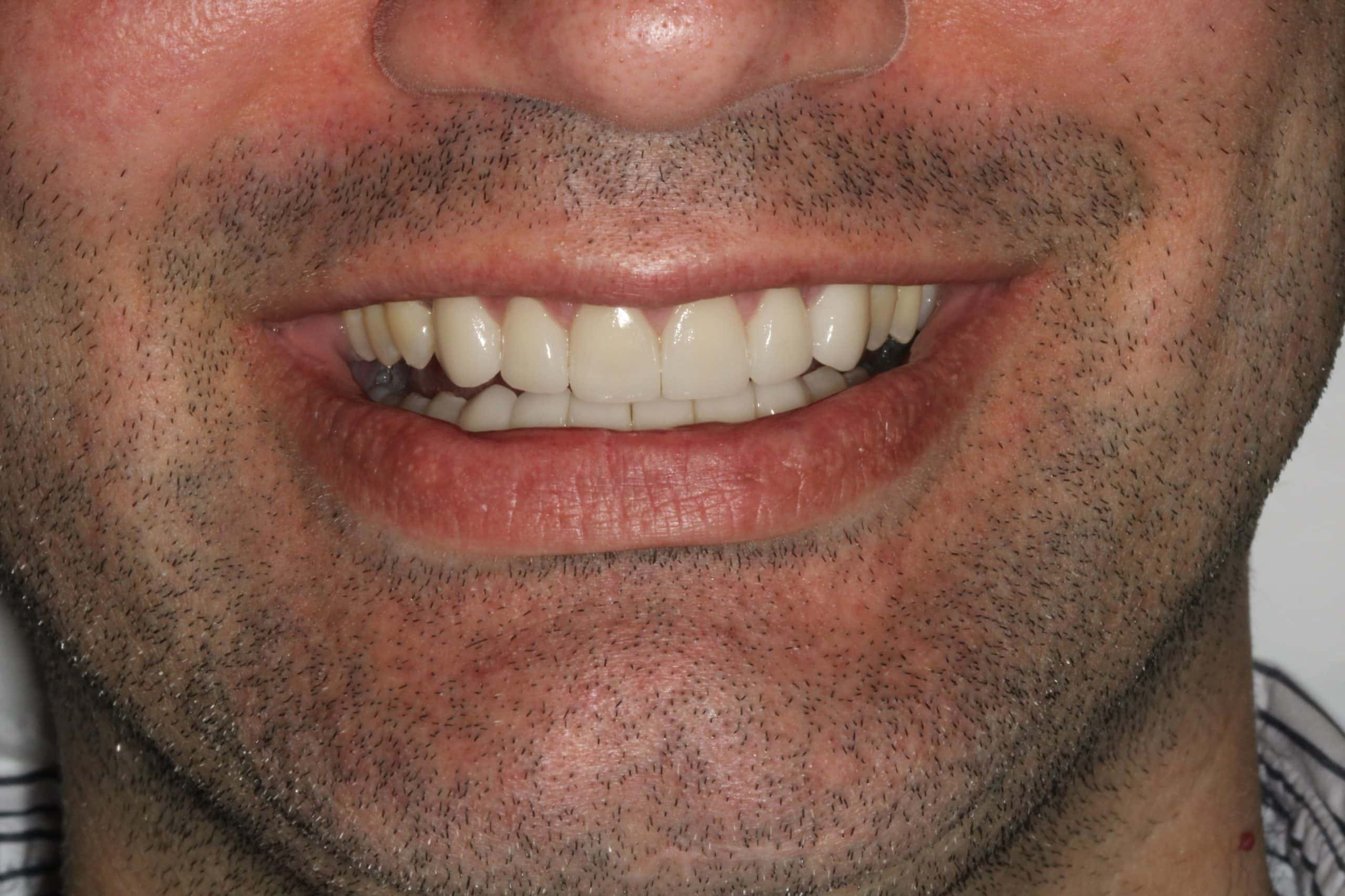 new, straighter teeth thanks to Invisalign and veneers