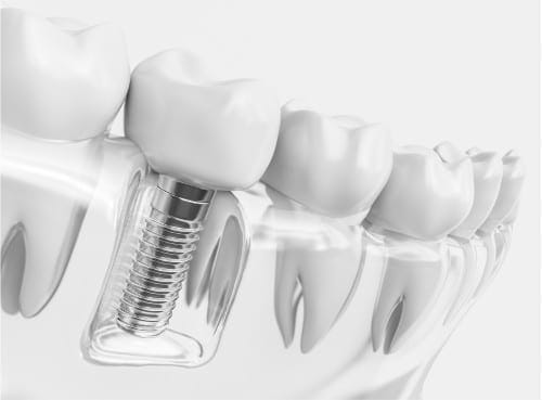 implant dentures tech image Dental implant replacing a missing tooth in the jaw