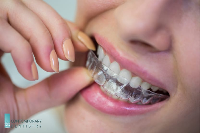 cosmetic Patient placing clear aligners on teeth for orthodontic treatment