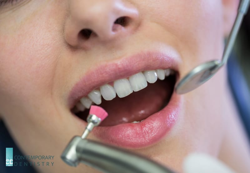 general dentist Dentist polishing teeth during a professional dental cleaning