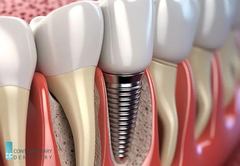 implant Dental implant placed in the jaw to replace a missing tooth