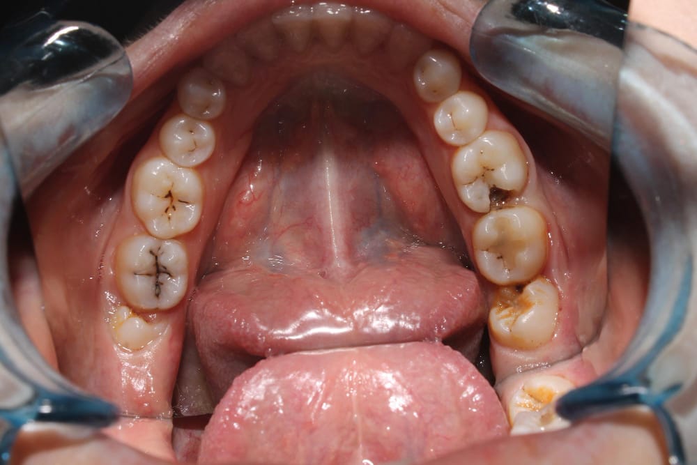 A close-up of molars with visible tooth decay and cavities.